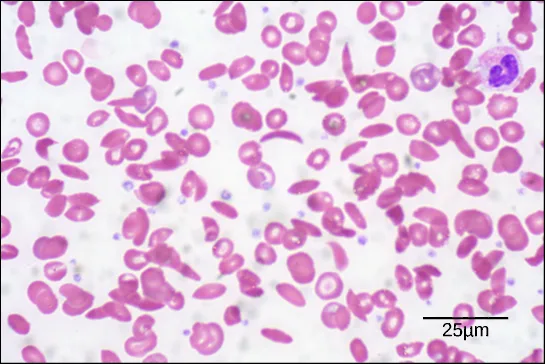 A bright-field light micrograph of red blood cells from a patient with sickle cell anemia. Most of the cells have a normal, disk shape, but about one in five has a sickle shape. A normal blood cell is eight microns across.