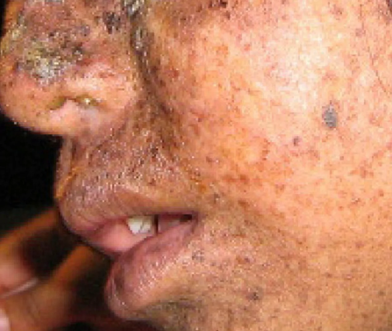 A close, side-on photo of the lower half of a person's face, showing extensive mottled, rough, dark brown and black skin lesions concentrated around the nose, cheek, and upper lip.