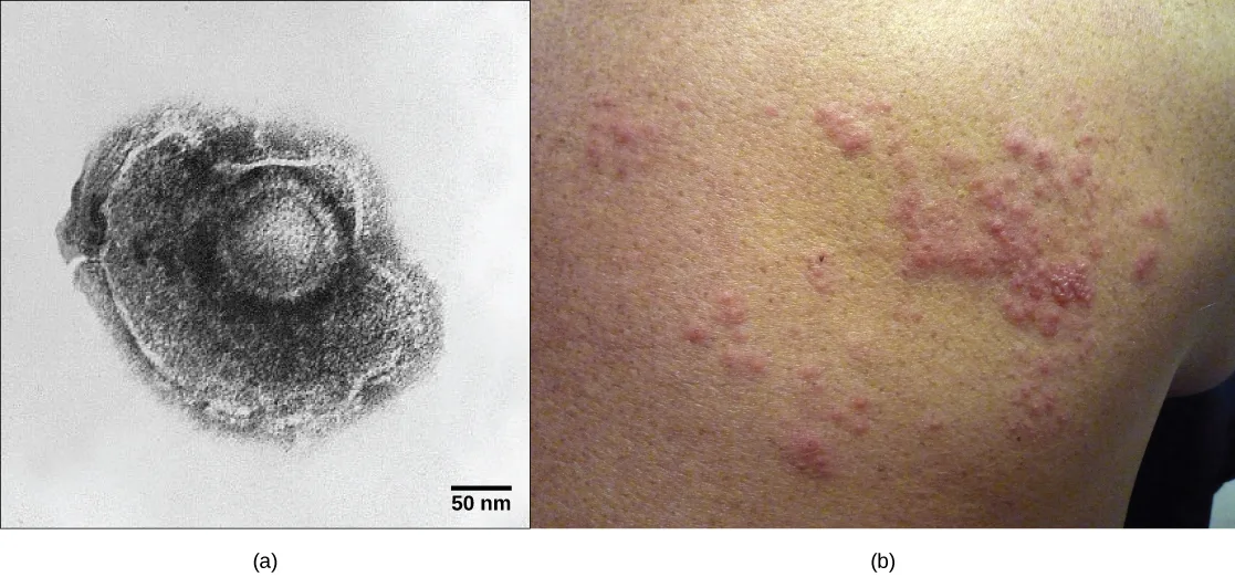 Two side-by-side images: (a) a transmission electron micrograph of a single varicella-zoster virus particle, showing a roughly round, irregularly textured envelope surrounding a lighter capsid at its center; (b) a photo of a person's shoulder and upper back with a cluster of small, raised, red-pink bumps and blisters forming a shingles rash.