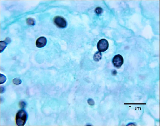 Micrograph of budding yeast cells: several round, dark blue-stained parent cells each with a smaller, teardrop-shaped bud attached to one side, scattered against a light blue-green background, with a 5 µm scale bar at lower right.