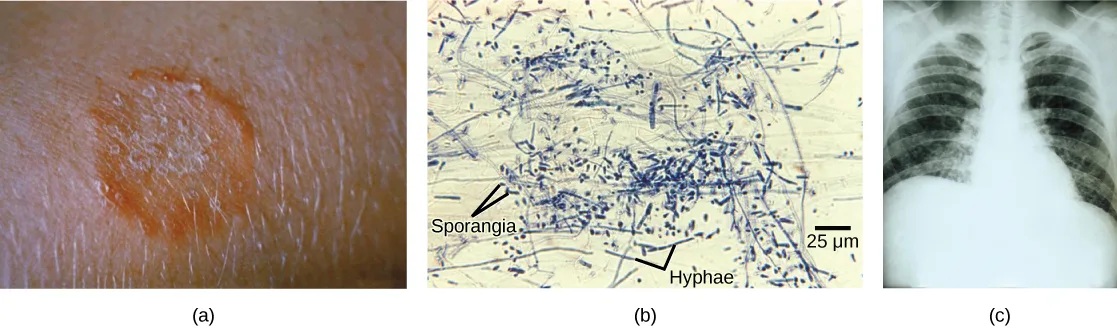 Three photographs side by side: (a) a close-up of a red, ring-shaped skin lesion; (b) a bright-field micrograph on a tan background showing tangled, thread-like hyphae with small oval sporangia, both labeled directly on the image with leader lines, and a 25 micrometer scale bar; (c) a chest X-ray showing both lungs mottled with patchy white streaks throughout.