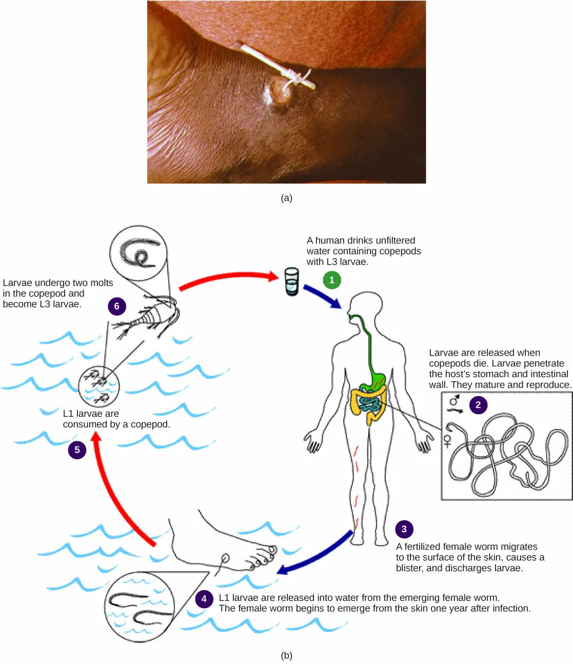 (a) A photo shows a thin white guinea worm emerging from a blister on a person's ankle, wound around a small stick. (b) A diagram of six numbered steps traces the guinea worm's life cycle between a human host and water-dwelling copepods.