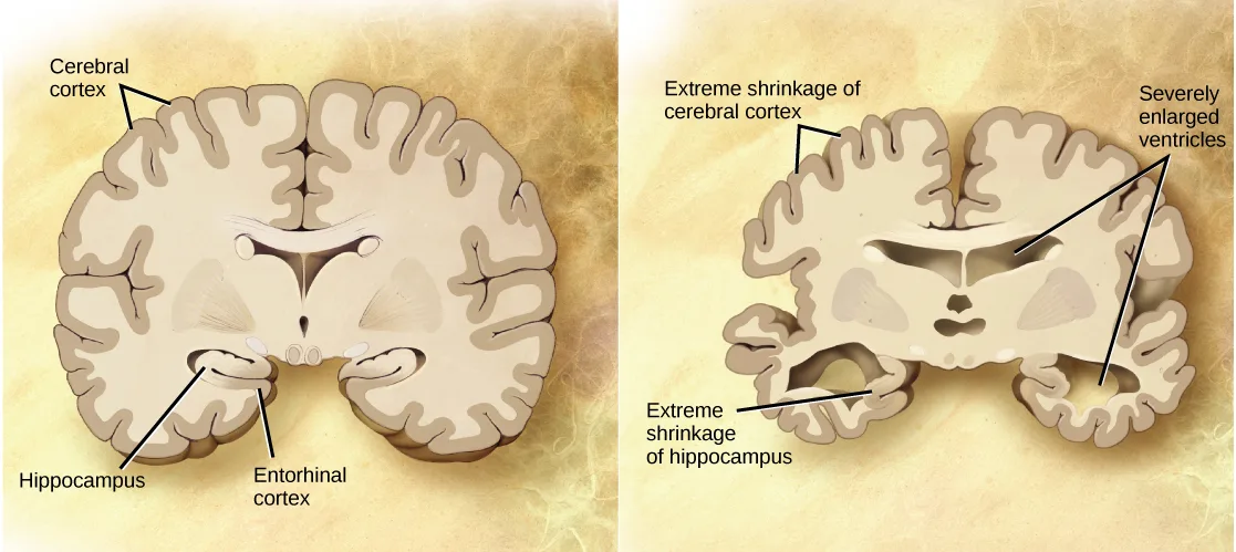 Two side-by-side labeled coronal cross-sections of a brain: a normal brain at left, its cerebral cortex, hippocampus, and entorhinal cortex labeled, and a visibly smaller, more deeply grooved brain at right with labels marking extreme shrinkage of the cerebral cortex and hippocampus and severely enlarged central ventricles.