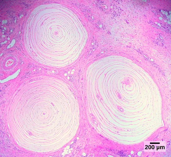 A photomicrograph showing three round, ringed Pacinian corpuscles, each resembling a cut tree stump in cross-section, embedded in the dermis.