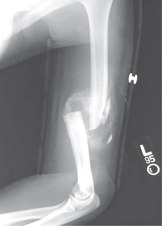 A grayscale X-ray image of a bent arm showing a fractured long bone with visible bone fragments at the break, plus small radiographic markers in the frame.