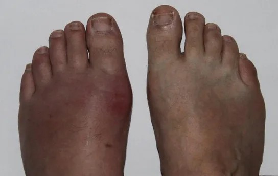 A person's bare feet viewed from above, side by side; the left foot is swollen and reddened around the big toe, while the right foot looks normal.