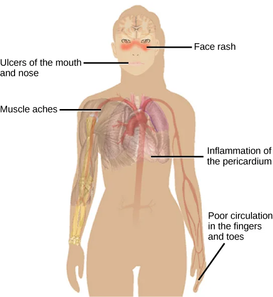 An illustration of a body with five leader lines pointing to affected regions: a red rash across the nose and cheeks, ulcers of the mouth and nose, muscle tissue in one arm, the heart and lungs beneath the ribs, and a blood vessel running to the hand.