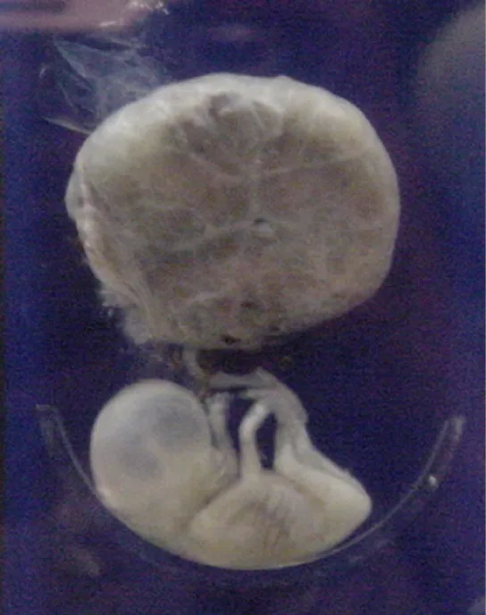A specimen jar shows a round, pale placenta at the top and a curled second-trimester fetus with long arms and legs beneath it, connected by a thin cord.