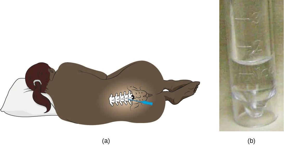 Panel (a) is a drawing of a person curled on their side with their head on a pillow, seen from behind; a lit patch on the lower back shows the vertebrae through the skin, and a blue needle enters between two of them at the base of the spine. Panel (b) is a photograph of a clear glass tube marked with volume graduations, holding a small pool of colorless fluid.