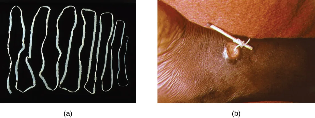 (a) A photograph of a long, flat, white worm folded back and forth on a black background. (b) A worm is being pulled out of a lesion on a patient's skin and wrapped around a matchstick.