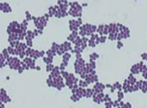 A micrograph showing dense, irregular clusters of small purple spherical cells.