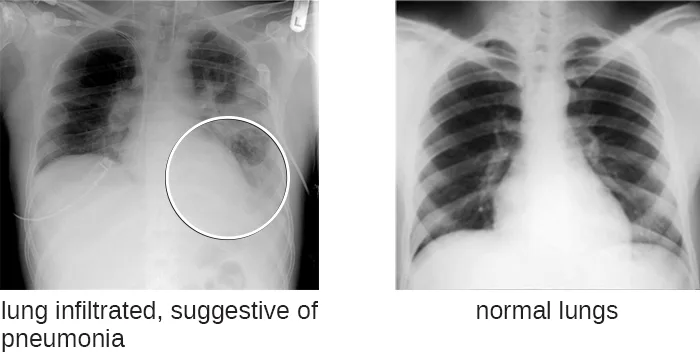 Two chest X-ray images side by side: the left radiograph, labeled lung infiltrated, suggestive of pneumonia, shows a hazy white patch in the lower right chest circled for emphasis; the right radiograph, labeled normal lungs, shows clear, evenly dark lung fields.