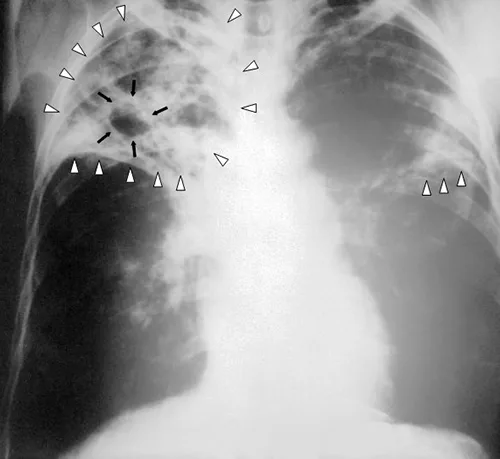 An anteroposterior chest radiograph. White triangles mark bilateral pulmonary infiltrates in both lungs, and black arrows outline a cavity in the right upper lung region.