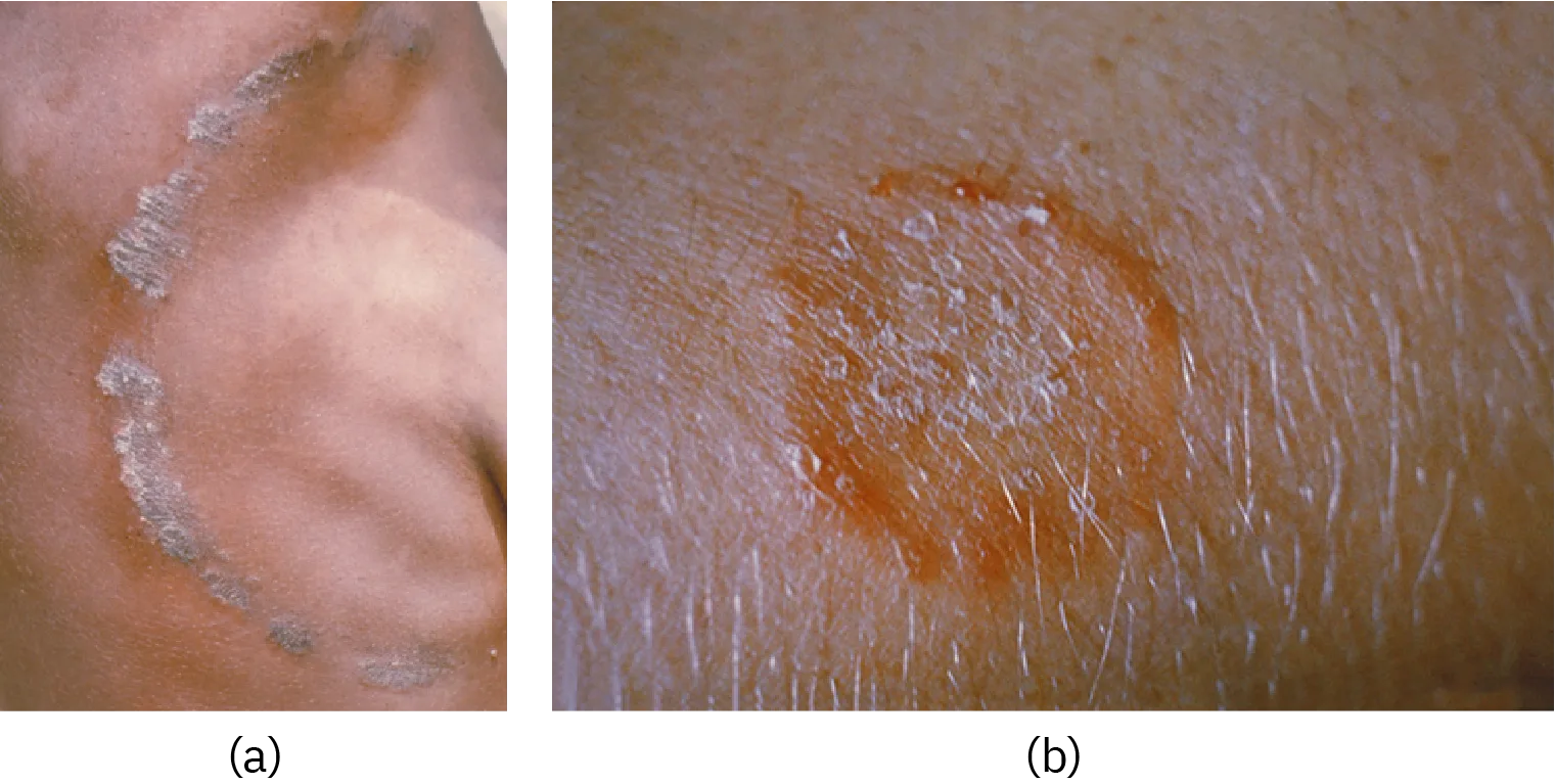 Two photographs of a ring-shaped rash on skin. In (a) the ring is grayish and scaly with a raised, uneven border on light brown skin. In (b) the ring is smaller and reddened, with a raised scaly border on lighter skin.