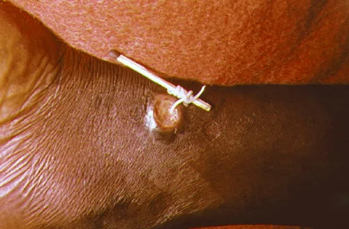 A close photograph of a thin, pale worm partly emerged from a small wound on a person's leg, wound around a matchstick.