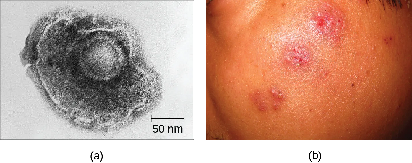 (a) A transmission electron micrograph of an enveloped, roughly round varicella-zoster virus particle with a scale bar marked 50 nm. (b) A photograph of a person's face and scalp showing several raised, fluid-filled red blisters clustered on one side.