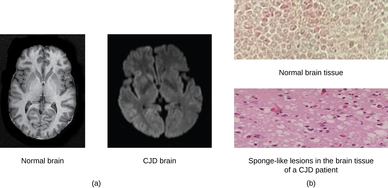 Panel a shows two side-by-side grayscale axial brain scans labeled Normal brain and CJD brain; the CJD brain scan is more uniformly hazy and blurred, with less distinct gray-and-white-matter detail, than the normal brain scan beside it. Panel b shows two stacked micrographs: normal brain tissue, a tight pink-stained cellular pattern, above tissue labeled sponge-like lesions in the brain tissue of a CJD patient, which is dotted with many pale round holes among the pink-stained cells.