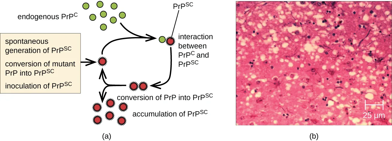 Panel a is a labeled flow diagram: green circles marked endogenous PrPC lead to a step labeled interaction between PrPC and PrPSc, shown as a green circle beside a red spiked shape marked PrPSc; a boxed list of three inputs — spontaneous generation of PrPSc, conversion of mutant PrP into PrPSc, and inoculation of PrPSc — feeds the cycle, which continues through conversion of PrP into PrPSc and accumulation of PrPSc, shown as growing clusters of red spiked shapes. Panel b is a micrograph of pink-stained brain tissue with pale round holes and dark-stained nuclei, and a 25 µm scale bar.
