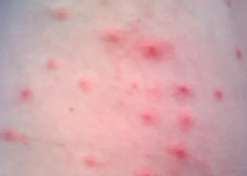 A close-up photograph of skin with numerous small pink and red raised bumps scattered across a rash.