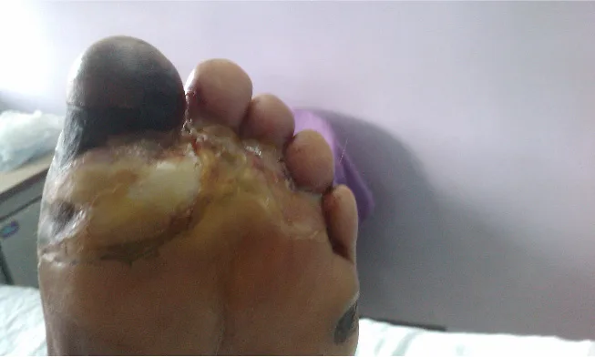 A close-up photograph of the sole of a foot: the heel is covered by a large area of blackened, dead skin, and the pad beneath the toes shows an open wound with raw, moist tissue and patches of loose, yellowish-white peeling skin.