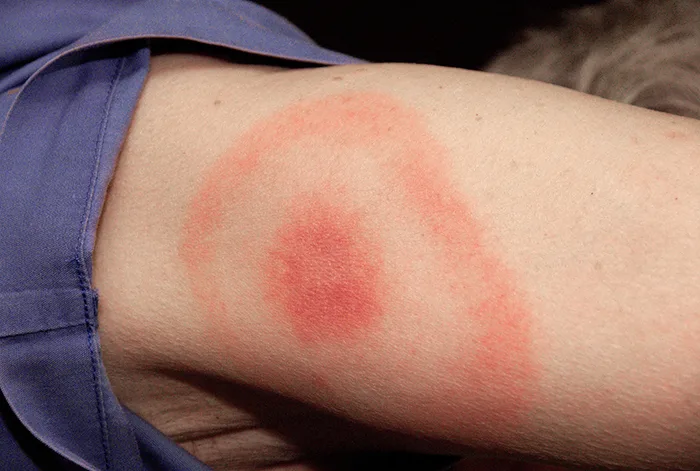 A close-up photo of a forearm with a bull's-eye rash: a solid red spot at the center surrounded by a paler ring of skin and then a fainter red ring.
