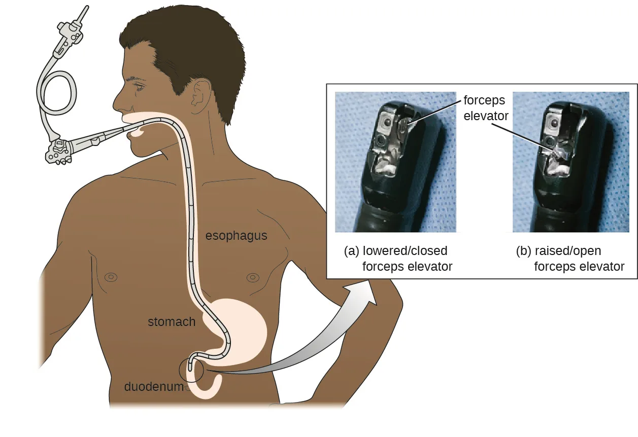 A drawing of a duodenoscope inserted through a person's mouth, down the esophagus and through the stomach, to the duodenum. Inset: two photographs of the scope's tip showing its forceps elevator in the lowered, closed position and in the raised, open position.