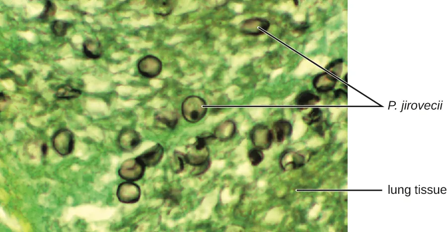 A light micrograph of green-stained lung tissue containing about a dozen dark, round to oval cells scattered through it; two of the dark cells are marked P. jirovecii by leader lines, and a leader line elsewhere marks the green background as lung tissue.