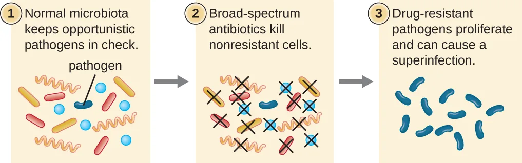 A three-panel diagram of superinfection. Panel 1, normal microbiota: a mix of orange rods, tan rods, orange wavy rods, and blue circles, with one dark-blue rod labeled pathogen. Panel 2, broad-spectrum antibiotics kill nonresistant cells: the same mix, most cells marked with a black X, but the pathogen rod and two blue circles unmarked. Panel 3, drug-resistant pathogens proliferate: many dark-blue rods matching the surviving pathogen, no other cell types.