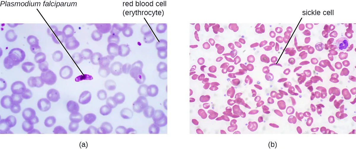 (a) A micrograph of round red blood cells with one darker, oval cell labeled Plasmodium falciparum and a nearby red blood cell (erythrocyte) labeled. (b) A micrograph of red blood cells, mostly round, with one crescent- or C-shaped cell labeled sickle cell.