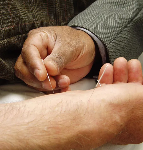 Close-up photo of a practitioner's hand inserting a thin acupuncture needle into another person's forearm, with a second needle already placed nearby.