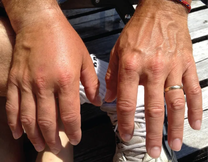A photograph of a person's two hands, palms down; the right hand is visibly more swollen than the left, with less-defined bone and tendon contours beneath the skin.