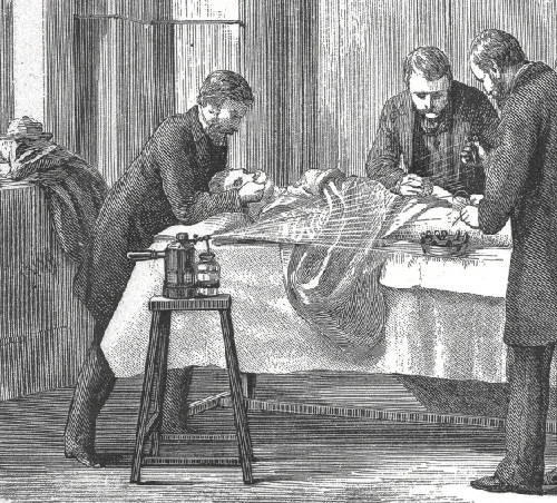A wood-engraved illustration of a Victorian-era surgery: three men in coats stand around a patient lying on a table draped in cloth, one bent over the patient's head and two working near the midsection, while a wheeled stand in the foreground holds a mounted apparatus with two canisters connected by tubing, spraying a fine mist over the surgical site.